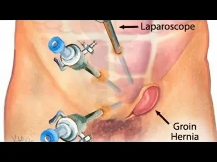 Minimally Invasive Hernia Repair in Auckland: A Complete Guide
